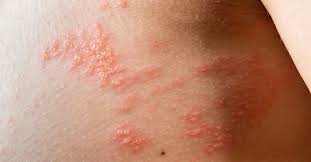 Image result for gonorrhea symptoms