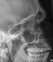 Image result for Sinus X Ray