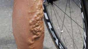 Cyclist janez brajkovic posts shocking picture of his leg muscles after race. Tour De France Polish Cyclist Pawel Poljanski Shows Off The Veins In His Legs After 16 Days On The Bike