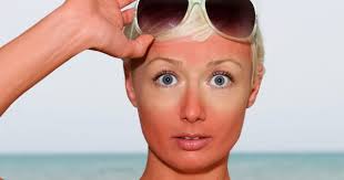Kulit berubah jadi warna lagi gelap daripada biasa. 8 Cara Cool Hilangkan Sunburn Di Muka