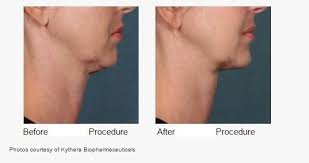 A New Treatment Designed To Melt Fat