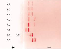 Hemoglobin Electrophoresis An Overview Sciencedirect Topics
