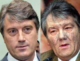 De la dioxine au novitchok, en passant par le polonium : Skin Growths Saved Poisoned Ukrainian President New Scientist