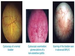 Image result for Interstitial Cystitis