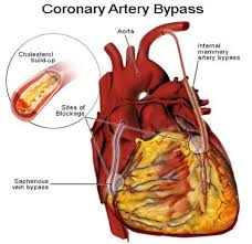 ViaÅ£a DupÄƒ OperaÅ£ia De Bypass Coronarian