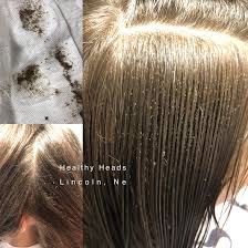 Great Example Of A Severe Case Of Lice Healthy Heads In Lincoln Ne Had Her Lice Free In Just A Couple Hours If You Look Louse Lice Removal Head Lice Remedy