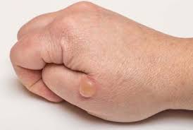 Home Remedies For Blisters Blister Remedies Essential Oils For Blisters Skin Blisters