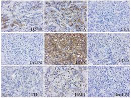 Ema (e29) mouse monoclonal antibody; Ijms Free Full Text Genomic Deletion Of Bap1 And Cdkn2a Are Useful Markers For Quality Control Of Malignant Pleural Mesothelioma Mpm Primary Cultures