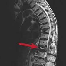 Nonsurgical options include activity restrictions, physical therapy, and treating osteoporosis. Compression Fracture Lower Back Pain Back Pain Treat Back Pain