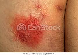 Om du kommer i kontakt med dessa sjukdomar, kontakta läkare omedelbart. Baltros Disease Herpes Blasor Kropp Body Obetanksam Virus Mansklig Sympton Skinn Canstock