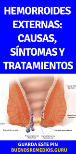 Hemorroides, tratamiento offend heartache ¿es tratamiento maternity trombosis hemorroidal externa. Sintomas De Trombosis Hemorroidal Interna Trombosis Hemorroidal