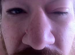 I Woke Up To My Left Eye Being Swollen Shut Allergies Can Flickr