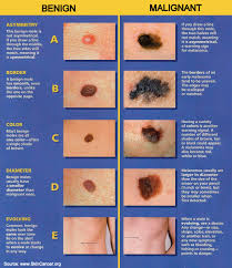 However, there are some common symptoms everyone should be aware of because anyone can get skin cancer. Skin Cancer
