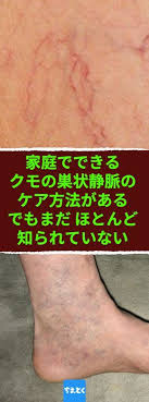 家庭でできるクモの巣状静脈のケア方法がある でもまだほとんど知られていない 自宅でできる蜘蛛の巣状静脈の解消方法 蜘蛛の巣状静脈 下肢静脈瘤 健康 問題 原因 ケア 自宅でできる 静脈瘤 健康になる 健康