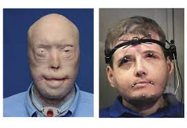 Fireman's mask melted disfiguring him, later he got a face transplant from a man who died in a cycling accident. Face Transplant Surgery Can Improve Speech In Victims Of Severe Face Trauma