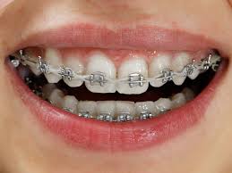 metal braketler
