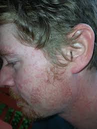 What should I do for skin irritation and infection after flood exposure in  Western North Carolina?