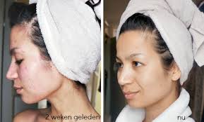 Snelle oplossing voor pigmentvlekken ⋆ Beautylab.nl