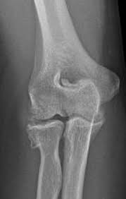 Despite the name, tennis elbow does not tennis elbow is very easy to diagnose. Lateral Epicondylitis And Beyond Imaging Of Lateral Elbow Pain With Clinical Radiologic Correlation Springerlink