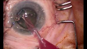 Image result for Cataract Extraction