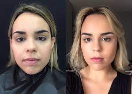 Este grupo foi criado para você tirar todas as dúvidas sobre. Antes Depois Da Bichectomia Apos Um Beleza De Farmacia Facebook