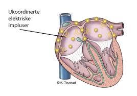 Nedsæt risikoen for blodpropper med den rette behandling. Hva Er Hjerteflimmer Atrieflimmer