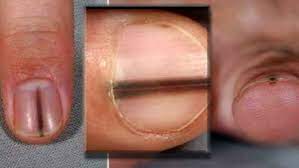 Alana severs, 36, from portsmouth, had ignored the tiny mark on her nail for years, using red nail polish to hide it as it made her feel embarrassed. Good 4 You Skin Cancer May Be Hiding In Unexpected Places Woai