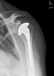 Image result for Shoulder XRay