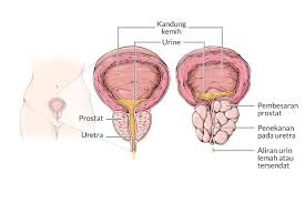 Sering mengalami mulut terasa asam disertai rasa perih di dada hingga ke tenggorokan? Bph Benign Prostatic Hyperplasia Gejala Penyebab Dan Mengobati Alodokter