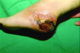If a burn scab (eschar) goes completely around a limb, it can tighten and cut off the blood circulation. Pertinent Treatment Insights On Heel Ulcers Podiatry Today
