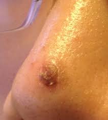 I'm cleaning it twice a day; What Wound Care Would You Recommend After Shave Biopsy Photos