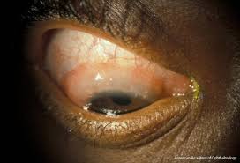 Image result for Vernal Conjunctivitis