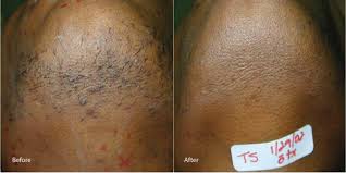 At rejuva medical aesthetics, we use the icon™ 1540 laser for scar removal treatments. Laser Hair Removal South Bay The Laser Image Company
