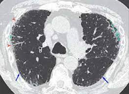 High incidence of mesothelioma and bronchogenic carcinoma. Asbestosis Knowledge Amboss