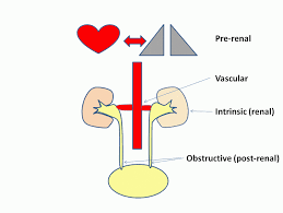 Image result for Postrenal Failure