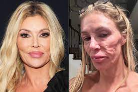 Everything We Know About Brandi Glanville's Mystery Facial Disfiguration