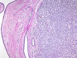 Malignant phyllodes tumors (mpt) have a poor prognosis, with most patients dying within 3 years after starting treatments 1. Webpathology Com A Collection Of Surgical Pathology Images