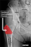 Image result for icd 10 code for nondisplaced intertrochanteric left hip fracture