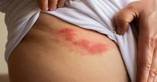 Image result for zoster under breasts