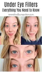 Under Eye Fillers For Dark Circles Before After Under Eye Fillers Undereye Botox Under Eyes