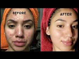 At its best, redness on your face can be annoying, but at its worst, it can be an indication of underlying health issues and a source of irritation, discomfort or. How To Remove Pimples Within A Week How To Get Rid Of Acne Within A Week How To Remove Pimples In 2021 Acne Scar Removal How To Get Rid