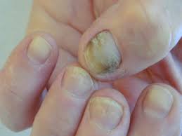 Résultat de recherche d'images pour "champignons des ongles"