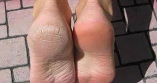 Oui Le Bicarbonate De Soude Permet D Eliminer Les Talons Crevasses Et Avoir Une Peau Douce Voici Comment L Utiliser Corne Pieds Peau Douce Soin Des Pieds
