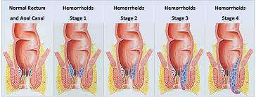 Hemorrhoids During Pregnancy Causes Symptoms And Treatment Health Care Qsota