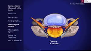 Despre discopatia lombara diagnosticul de discopatie sugereaza o stare patologica anormala a discului lombar. Radiculopatia Cervicala Durerea De Brat Dr Dan Martin