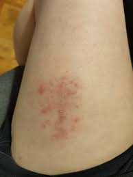 Image result for koebner phenomenon psoriasis