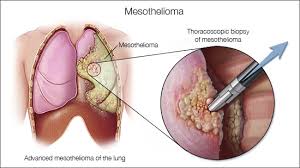 Not everyone who's around it gets. What Are The Symptoms Of Mesothelioma Quora