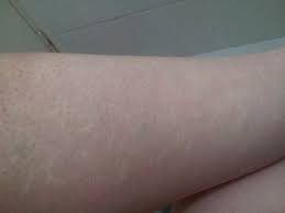 This is why several laser. White Bumps After Laser Hair Removal Will It Get Better Photo