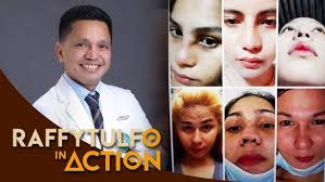 MY GORETEX SEPTORHINOPLASTY JOURNEY BY DR ALFRED DIZON OF PAMPANGA