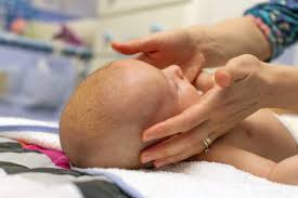 Image result for Cradle Cap
